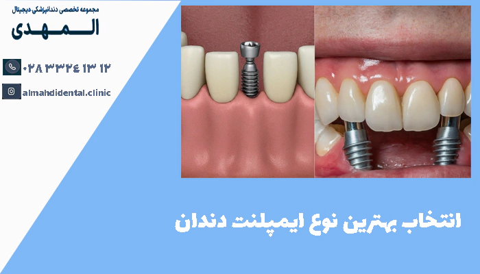  انتخاب بهترین نوع ایمپلنت دندان