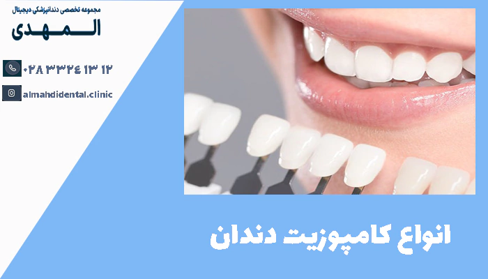 انواع کامپوزیت دندان
