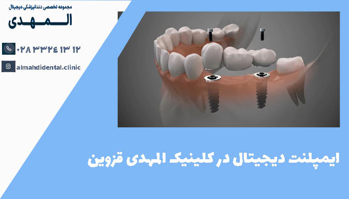 ایمپلنت دیجیتال در کلینیک المهدی قزوین
