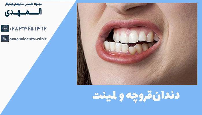  دندان‌قروچه و لمینت