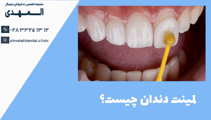 لمینت دندان چیست؟