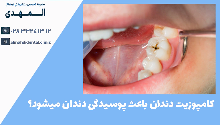 کامپوزیت دندان باعث پوسیدگی دندان میشود؟