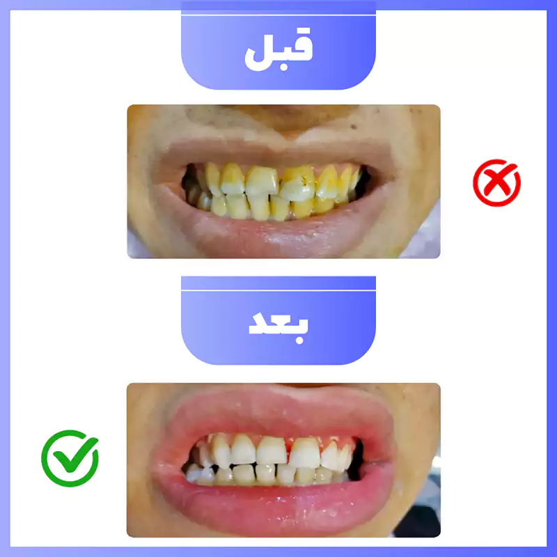 بلیچینگ دندان قبل و بعد