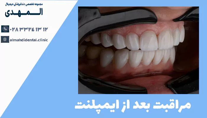 مراقبت بعد از ایمپلنت