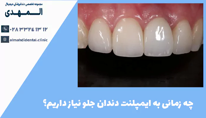 چه زمانی به ایمپلنت دندان جلو نیاز داریم؟